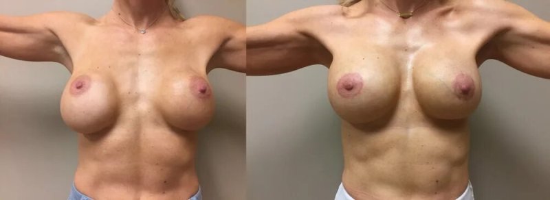 Tits of girls with implants, Naked big tits with implants, Tits Implants